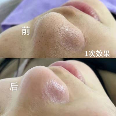 美容院毛囊清洁霜深度去黑头粉刺闭口角质清洁毛孔面部按摩膏批发图2