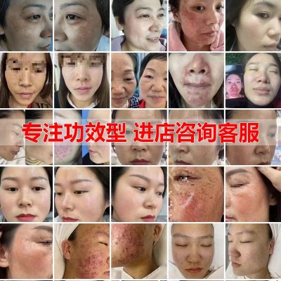美容院专用五天徒手清斑揉斑术无尴尬期祛斑霜雀斑妊娠斑排黑色素图3