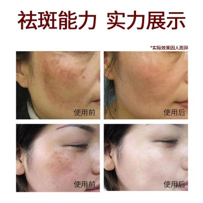院线专供美白炸斑精华液分解色素去雀斑黄褐斑无尴尬祛斑液淡斑液图3